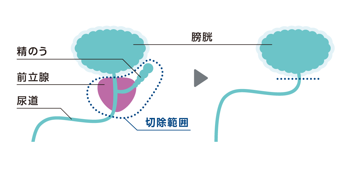 全摘手術の様子