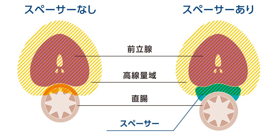 スペーサーの有無の違い