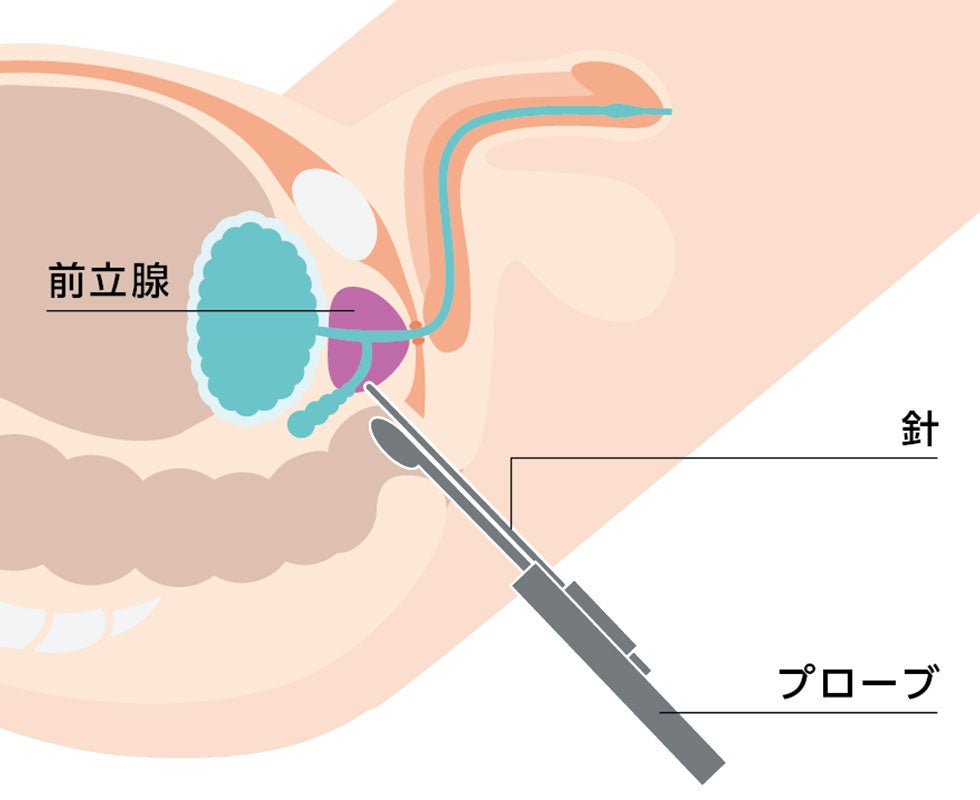 経直腸式の様子